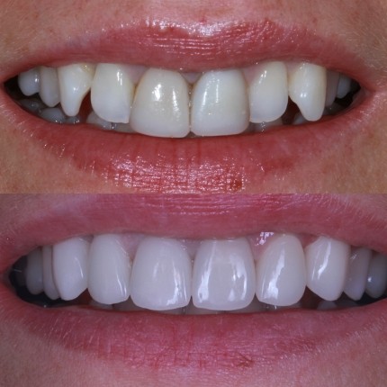 Зміна форми та кольору зубів