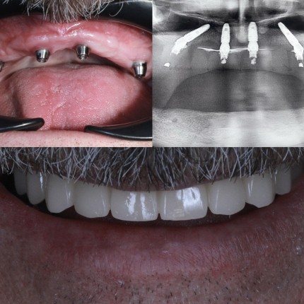 Втрачені зуби- це імплантація 