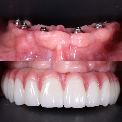 Відновлення втрачених зубів на верхній щелепі за допомогою цирконієвих коронок та імплантантів. 