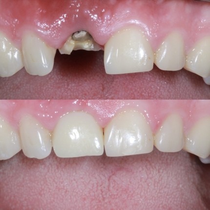 Зуб за 1 годину