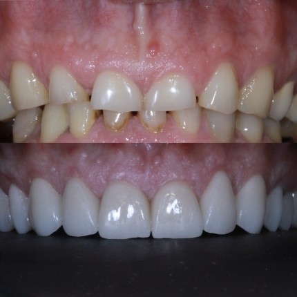 Тотальна естетично-функціональна реконструкція зубів